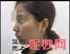 臨滄整（zhěng）形美容醫院人民醫院做隆鼻好不好？醫院介紹（shào）附（fù）案例和價格表！