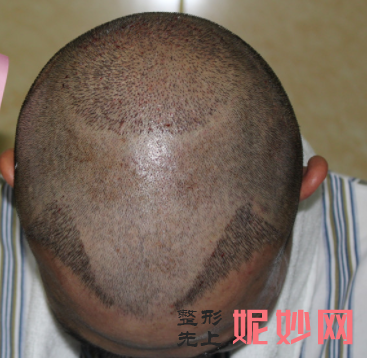 葫蘆島（dǎo）頤正醫療美容門診部靠譜（pǔ）嗎，附發際線種植（zhí）案例_價格（gé）表