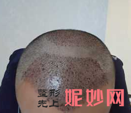 合肥（féi）瑤海福華醫療美容門診部簡介,附上發際線種（zhǒng）植收費表及案例