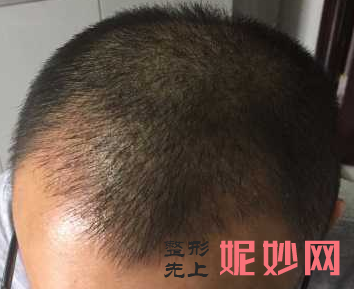 合肥瑤海福華醫療美容門診部簡介,附上發際線種（zhǒng）植收費表及案例