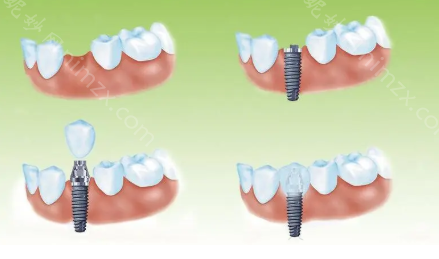 惠豐口腔種植（zhí）牙多少錢?看2023惠豐口腔種植牙價格表