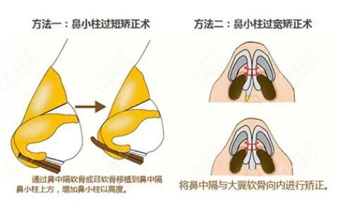 鼻小柱歪斜（xié）如何修複?要多少錢（qián）?具體情況（kuàng）具體分析