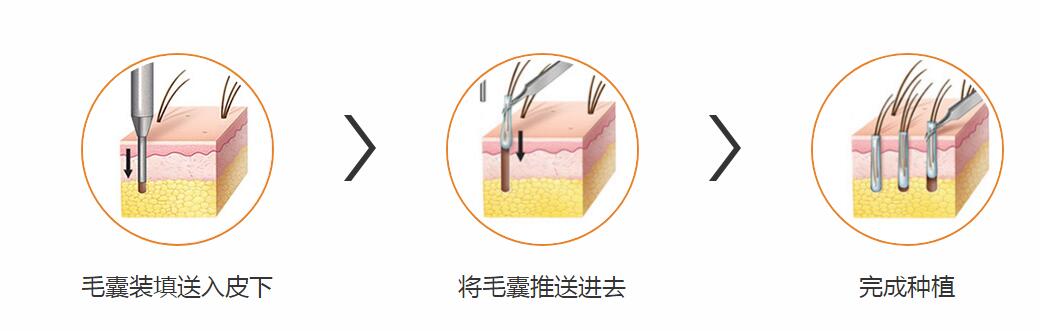 南寧貞韓微創無痕植發技術 防脫、固發、生發、植發均可見效果