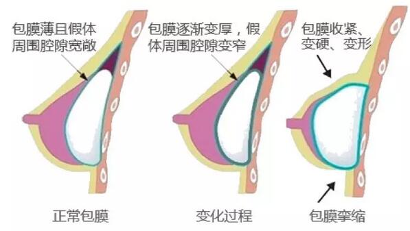 南寧賀（hè）爾美詳解假體隆胸手術後，乳（rǔ）房嚴重變形、疼痛的原因