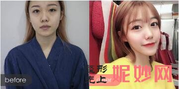 太原美之（zhī）妍醫院整形技術怎麽樣?坑人不?美之妍曹立銘雙眼皮案例（lì）效果（guǒ）及價格（gé）