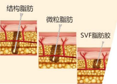 哈爾濱歐蘭仁美醫院：全麵部（bù）填充一次體驗 即可定格麵部美麗